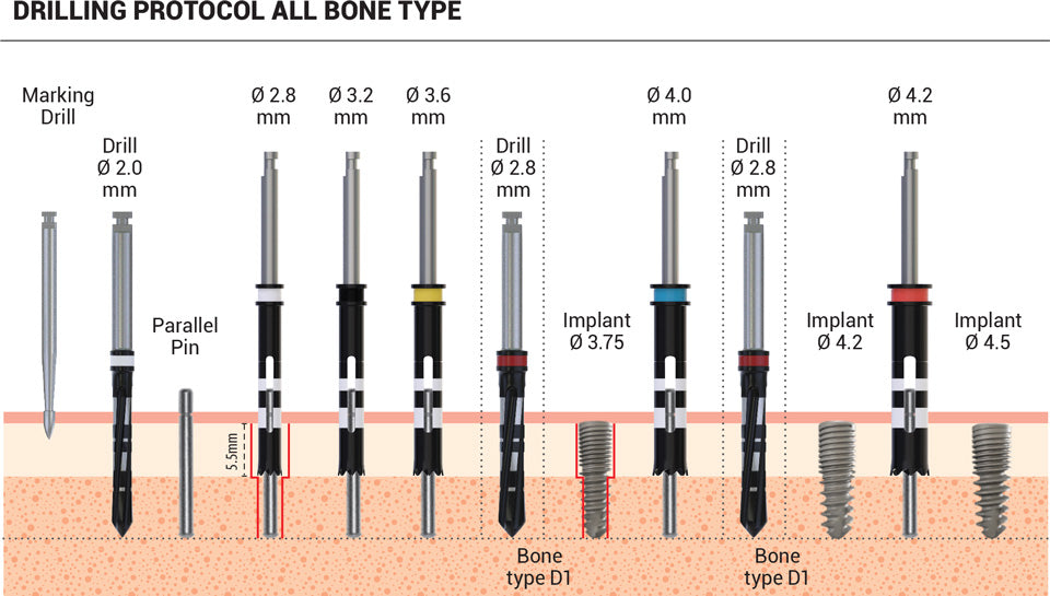 Smart Dual Thread Spiral Implant