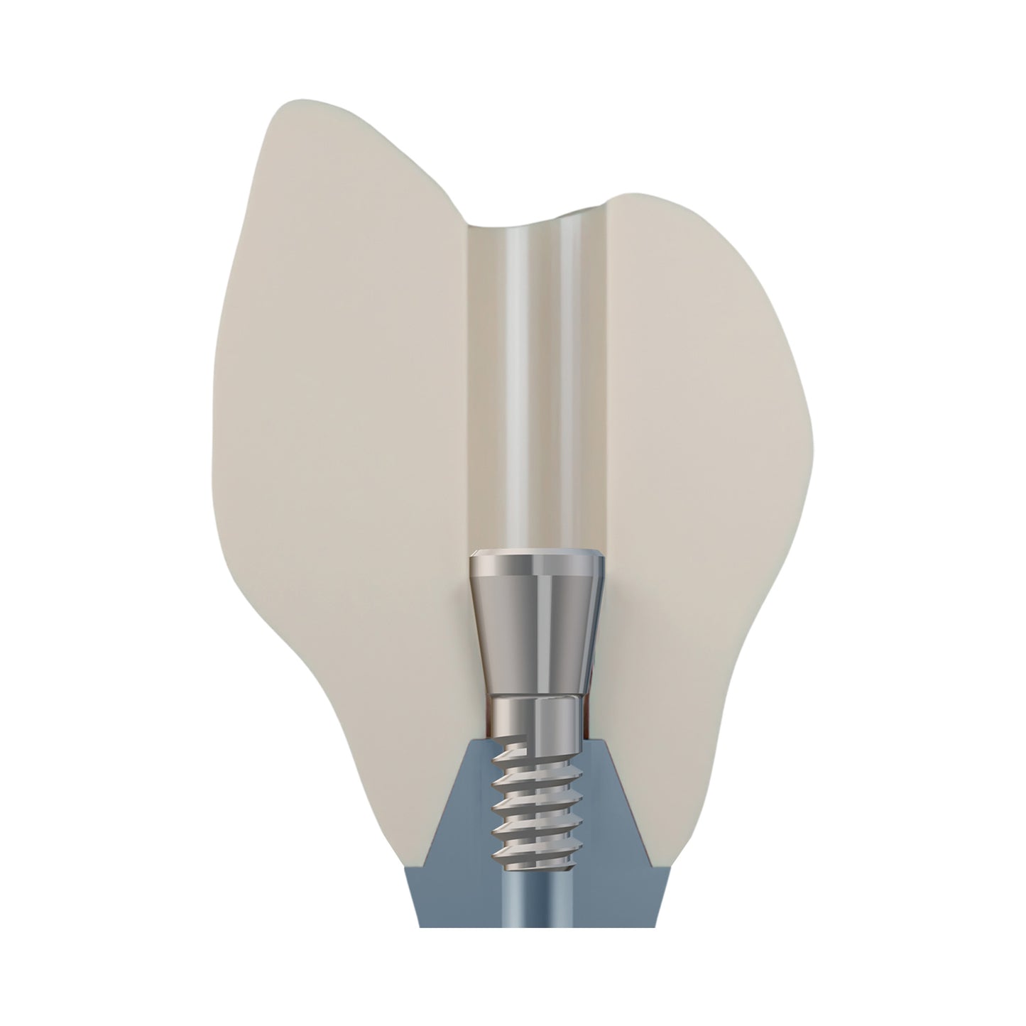 DSI EvoConnect M1.4 - Direct Сonnection Screws for Multi-Unit Abutments