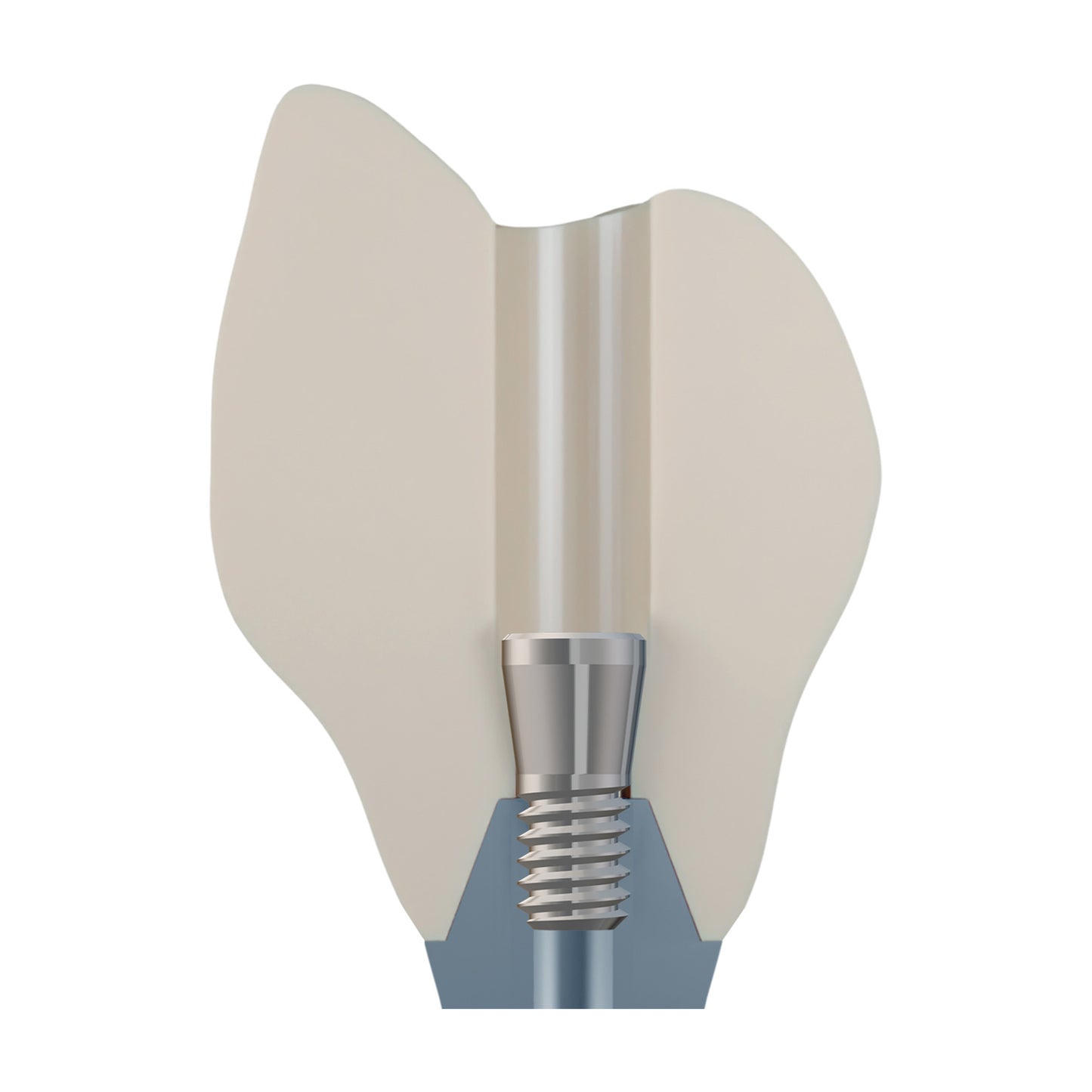 DSI EvoConnect M1.7 - Direct Сonnection Screws for Multi-Unit Abutments